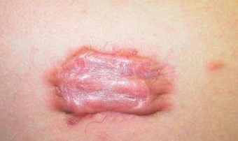 青島皮膚病醫院#吉林10年疤痕疙瘩患者病例介紹