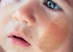 青島哪家醫(yī)院治療胎記比較好?胎記的4個(gè)類型分析